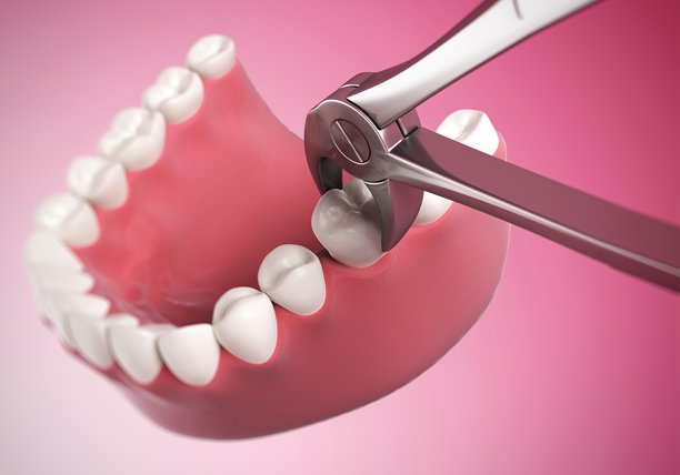 Gum Graft surgery Gum Graft surgery