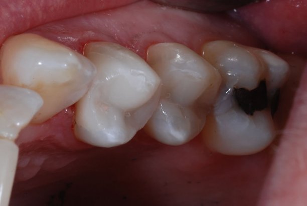 Gum Lift surgery Gum Lift surgery