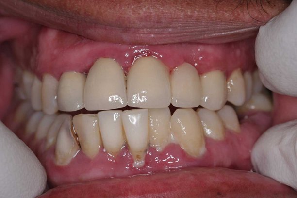 Periodontal disease Bone Regeneration Periodontal disease Bone Regeneration