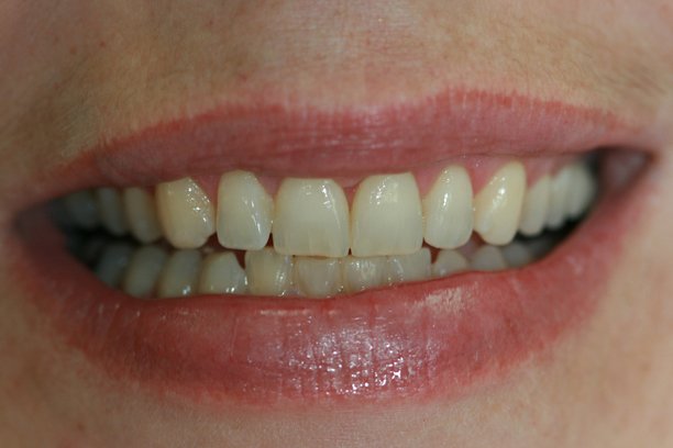 Pocket reduction procedures Pocket reduction procedures