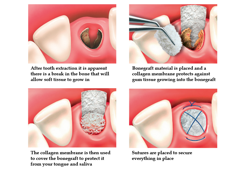 Bone Grafting for Implants Bone Grafting for Implants