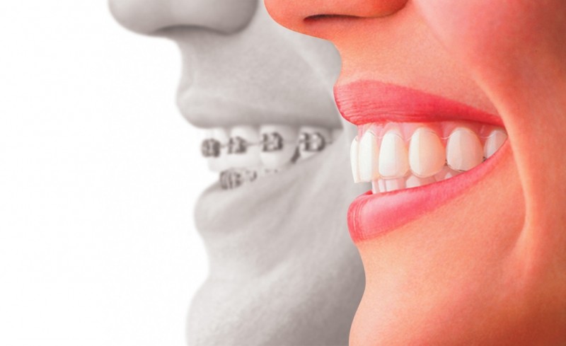 Invisalign® FAQs Invisalign® FAQs