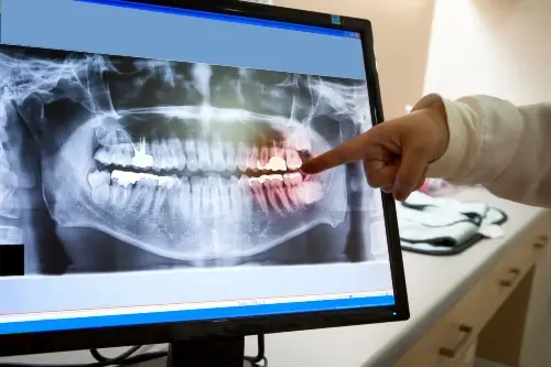 Endodontic Sedation Endodontic Sedation