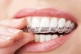Invisalign Treatment Process and Its Benefits