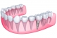 The guide to dental implants