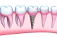 How Long Do Dental Implants Last?