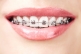 Pros and cons of different types of braces